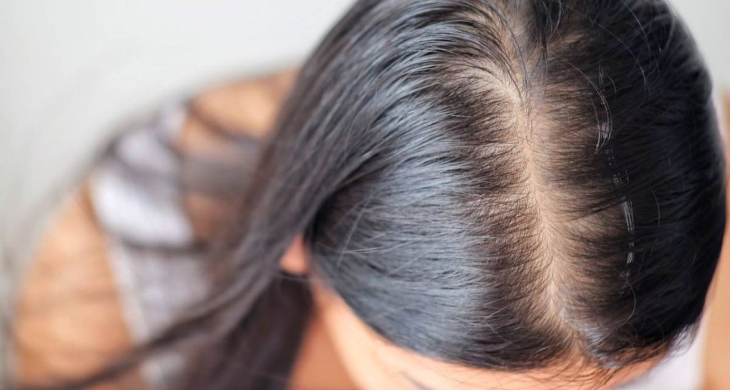 درمان ریزش موی آندروژنیک در زنان