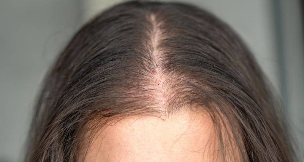 دلایل و درمان های الگوی طاسی زنانه