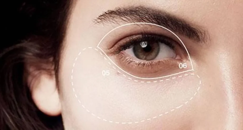 رفع تیرگی زیر چشم