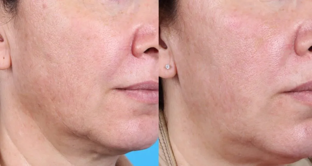 روش های افزایش ماندگاری پی آر پی صورت