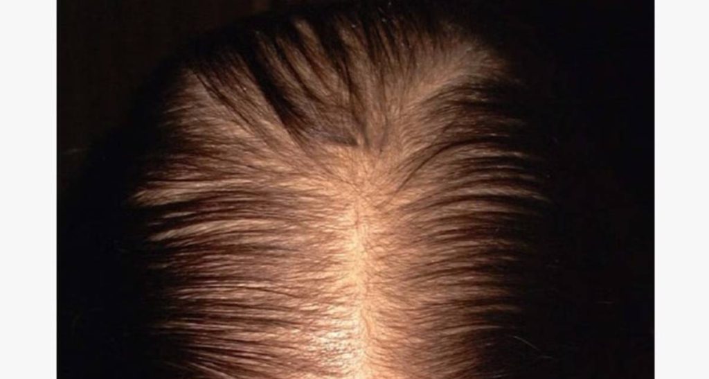 ریزش مو آندروژنیک در زنان