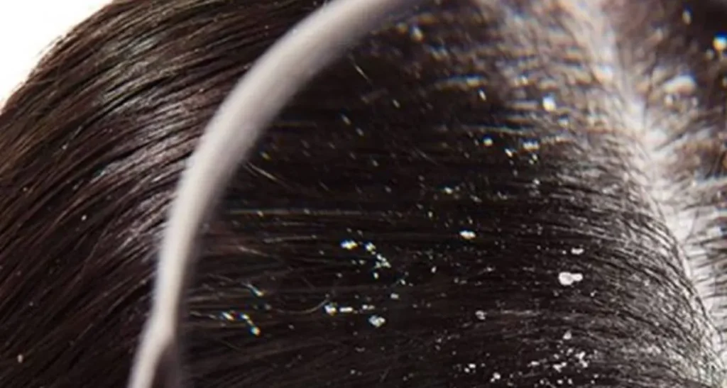 سفیدک چسبیده به مو