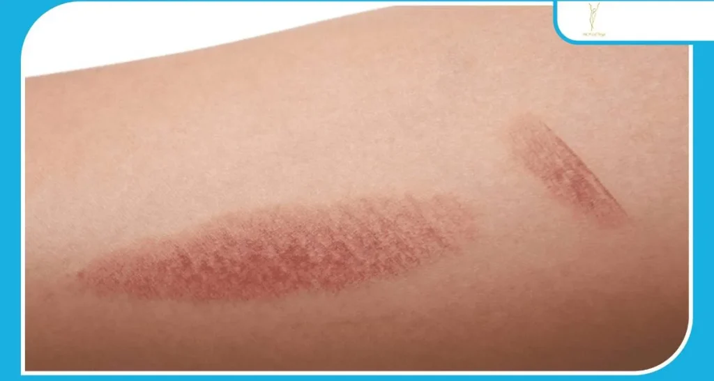 رفع لک های ناشی از سوختگی لیزر