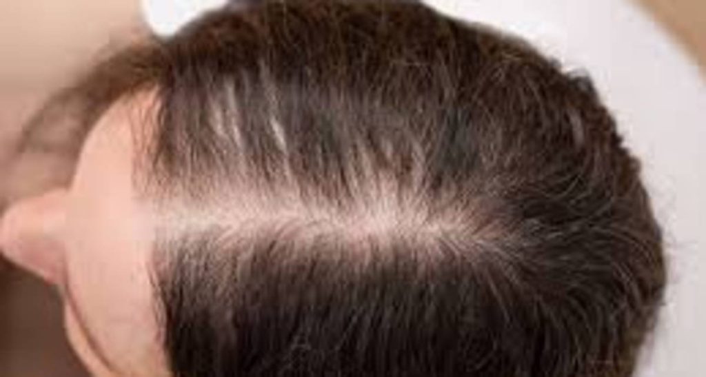 علت و درمان ریزش موی آندروژنیک در زنان