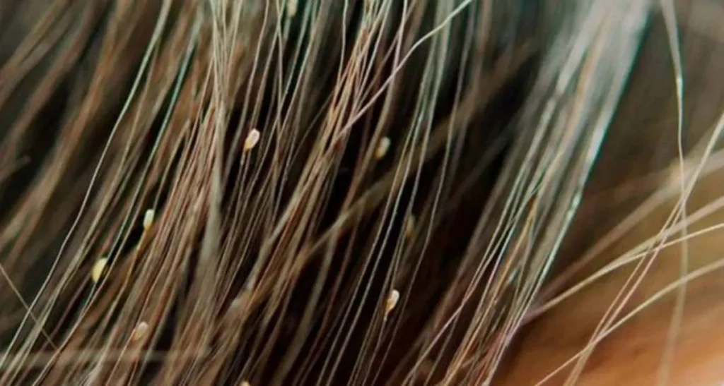 علت پوسته پوسته شدن پوست سر و درمان آن