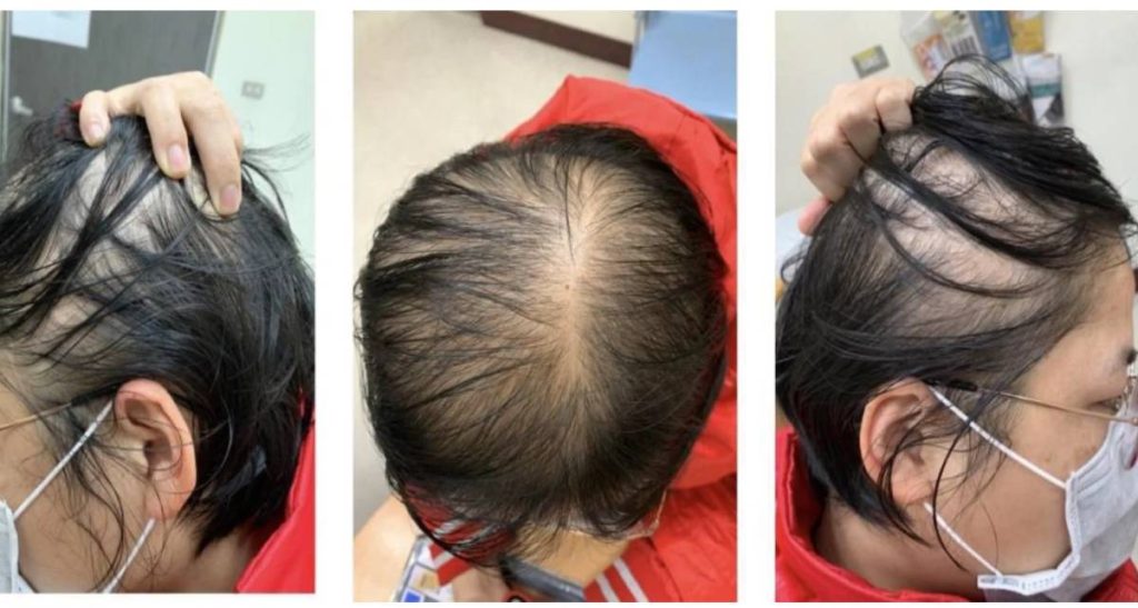 علل ریزش موی آندروژنیک در زنان