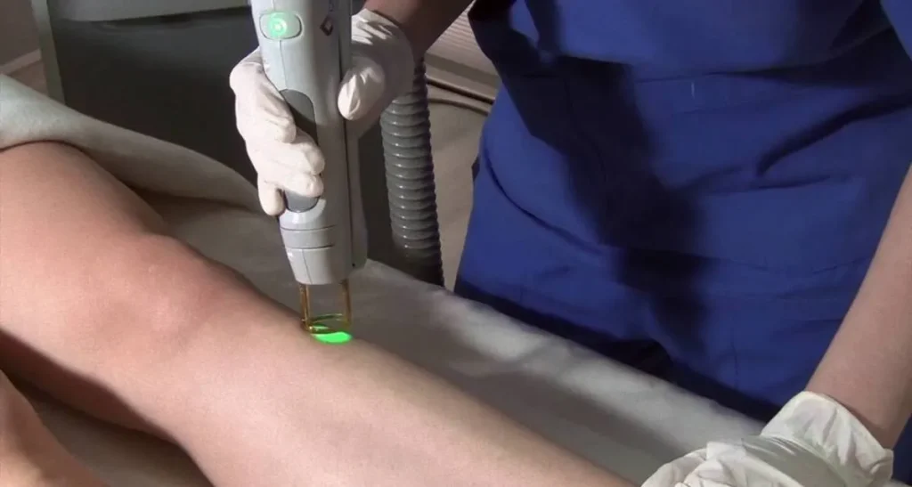 لیزر شاتی بهتره یا رولی