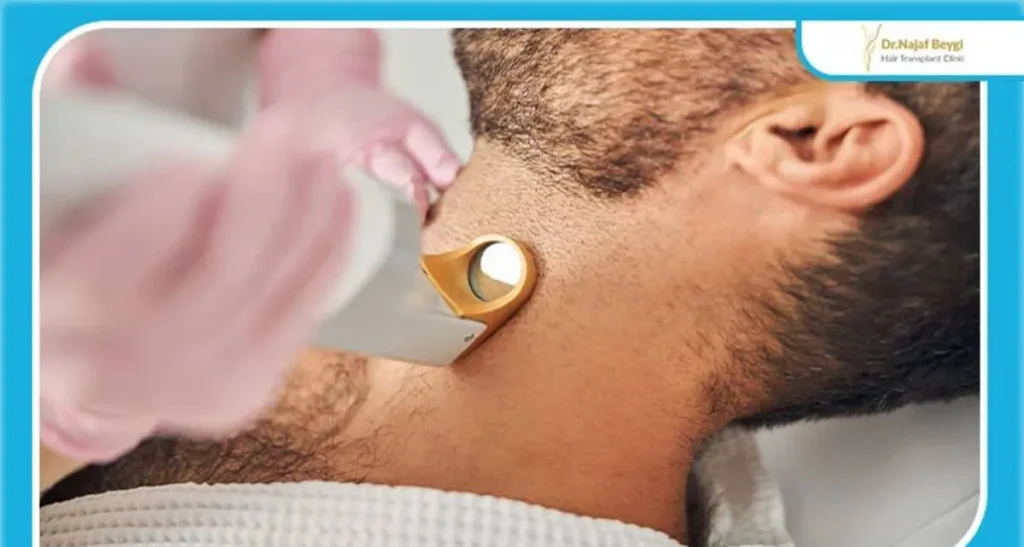 لیزر موهای زائد آقایان مزایا