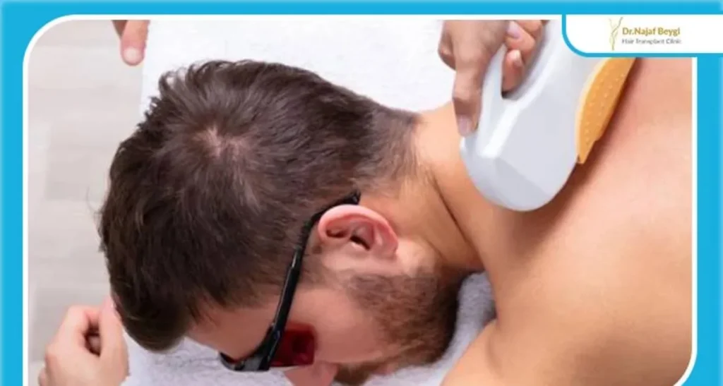 لیزر موهای زائد در آقایان