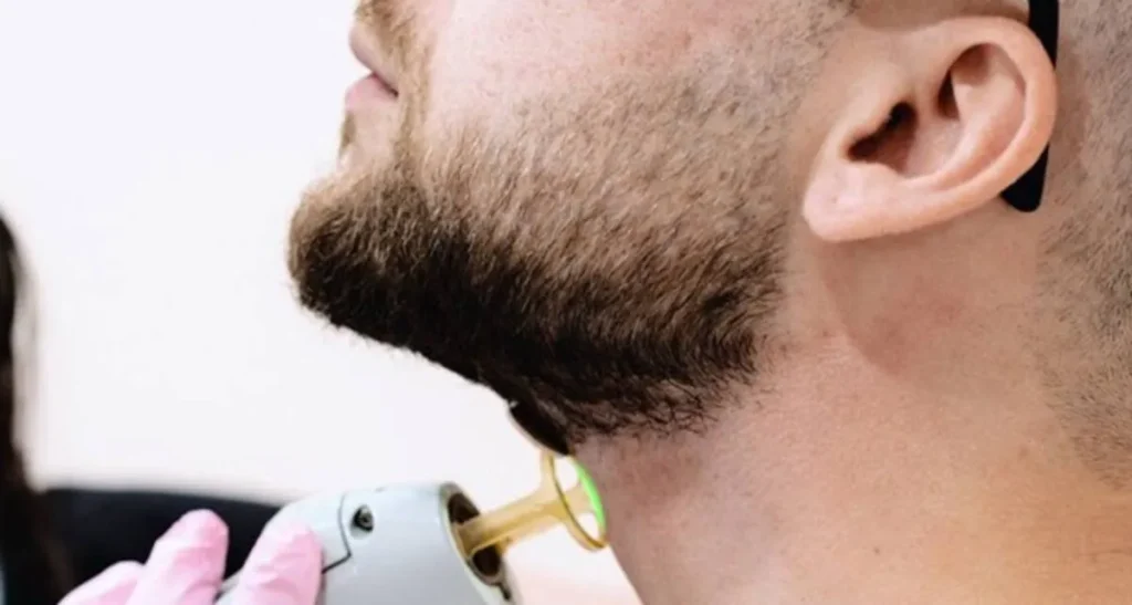 لیزر موهای زائد در مردان