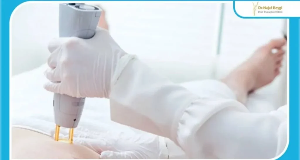 لیزر موهای زائد مردان