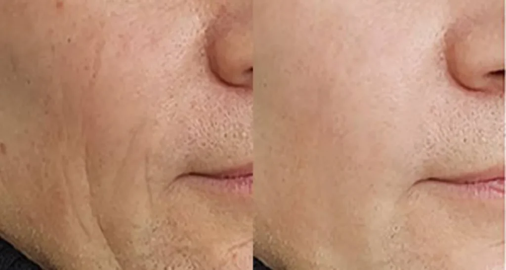 ماندگاری پی آر پی صورت چند سال است؟