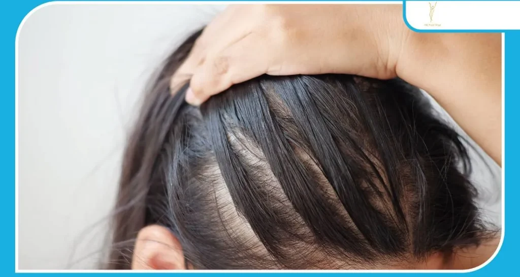 آیا کاشت مو برای زنان جواب می دهد؟