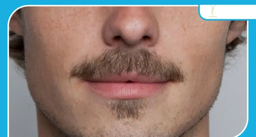 بهترین کلینیک کاشت ریش و سبیل در سعادت آباد