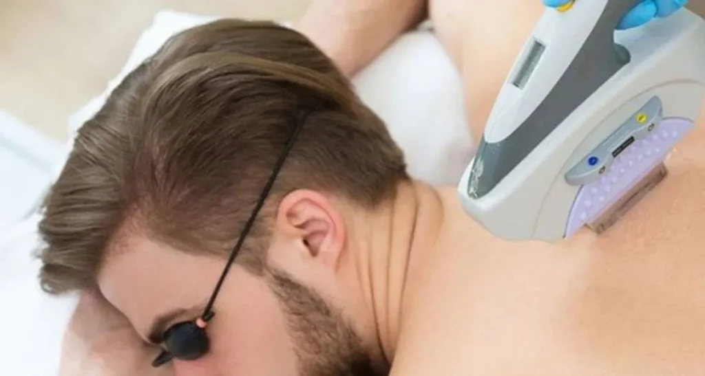 نکات لیزر موهای زائد مردان