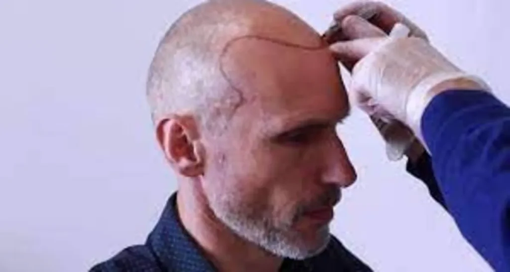 هزینه اسکالپ سر