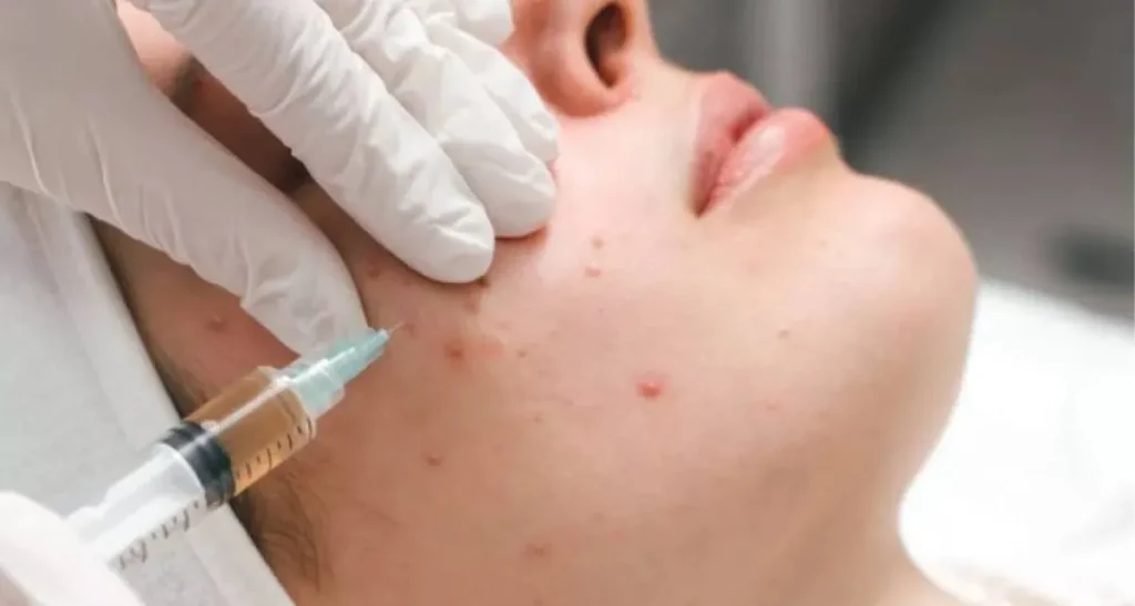 همه چیز در مورد ماندگاری پی آر پی صورت