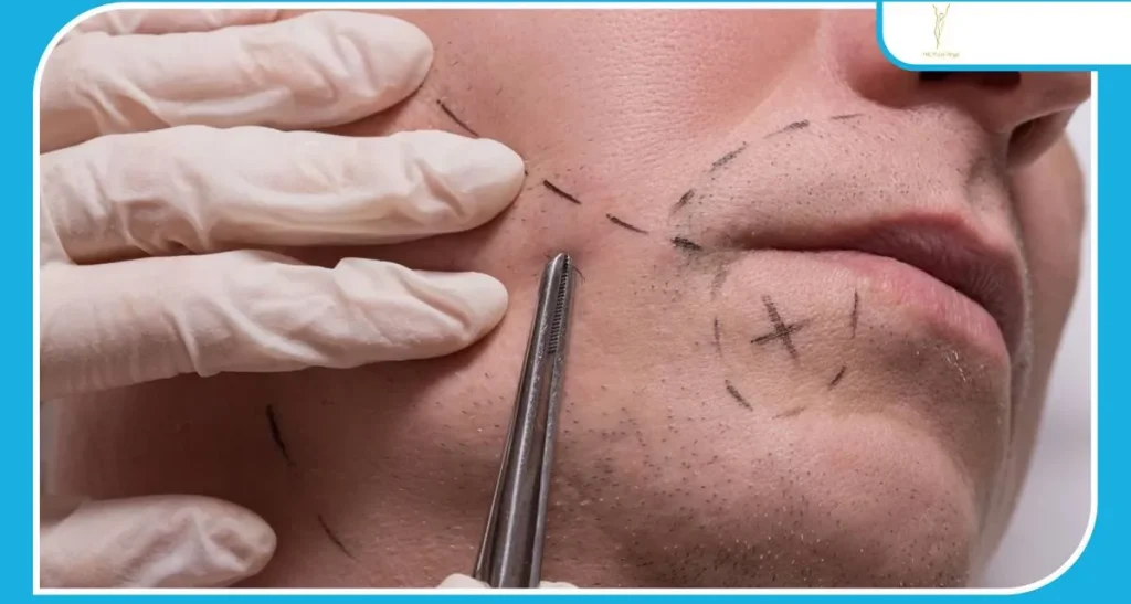 بهترین کلینیک کاشت ریش و سبیل در تهران