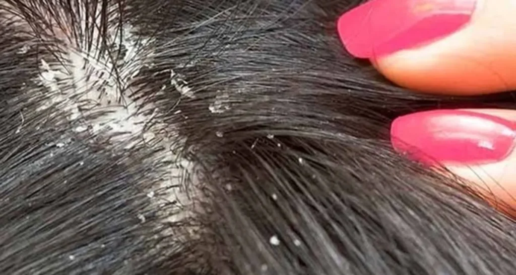 پوسته های چسبیده به مو