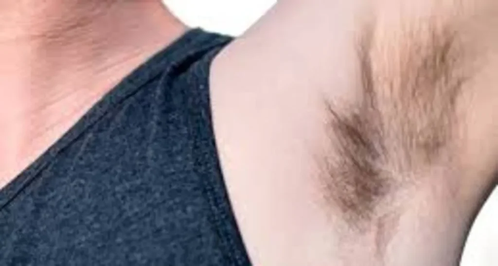 کاشت موی سر از زیربغل