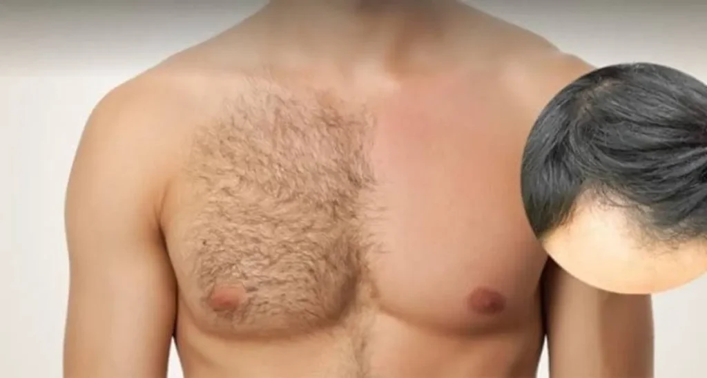 کاشت موی سر از زیر بغل