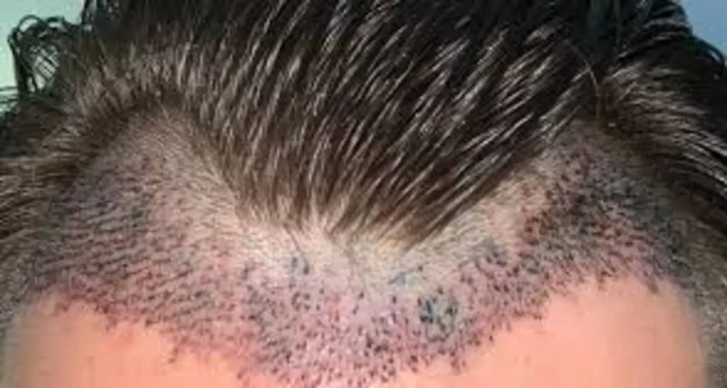 کاشت مو از زیربغل