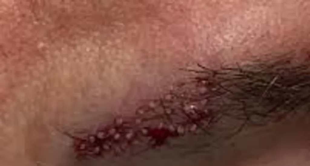 کاشت مو با روش bht