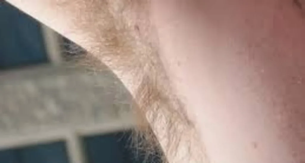 کاشت مو به روش BHT