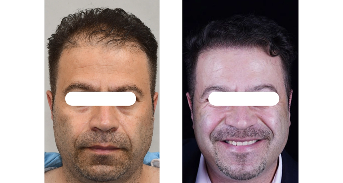 آیا کاشت مو بدون درد و خونریزی