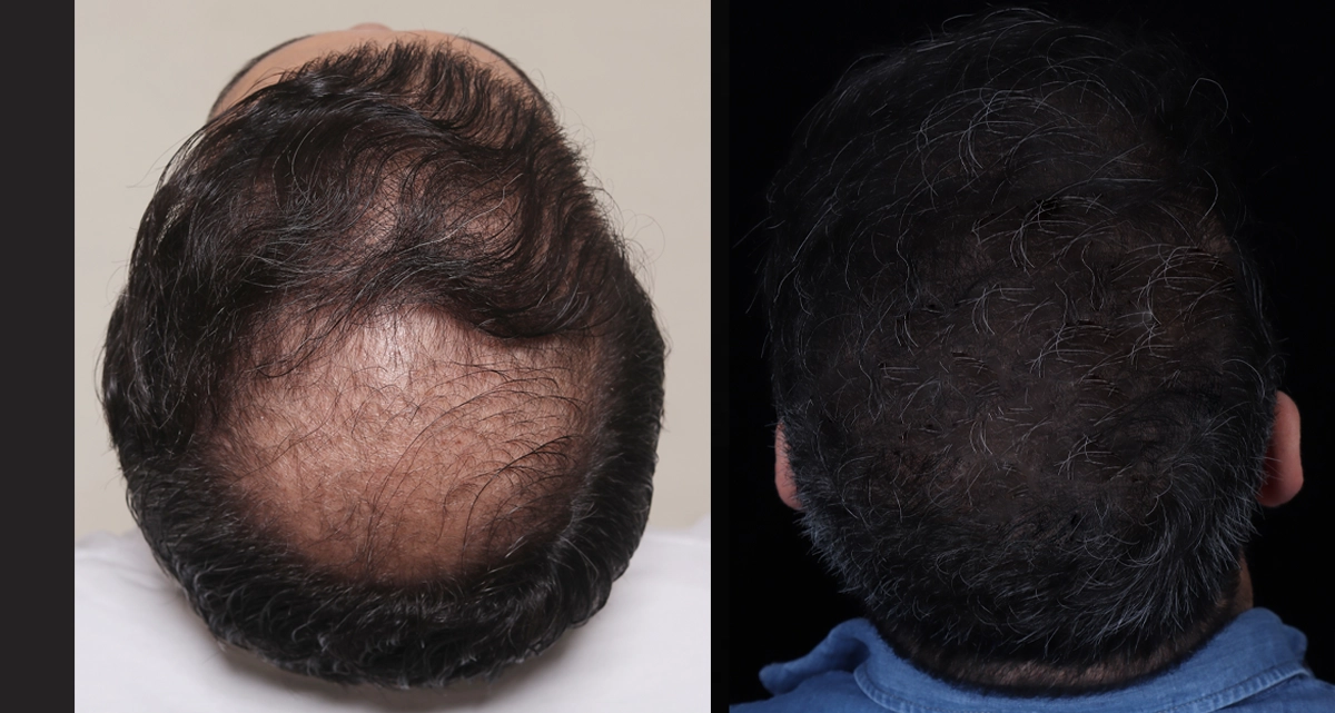 مراقبت‌های قبل و بعد از کاشت مو بدون جراحی