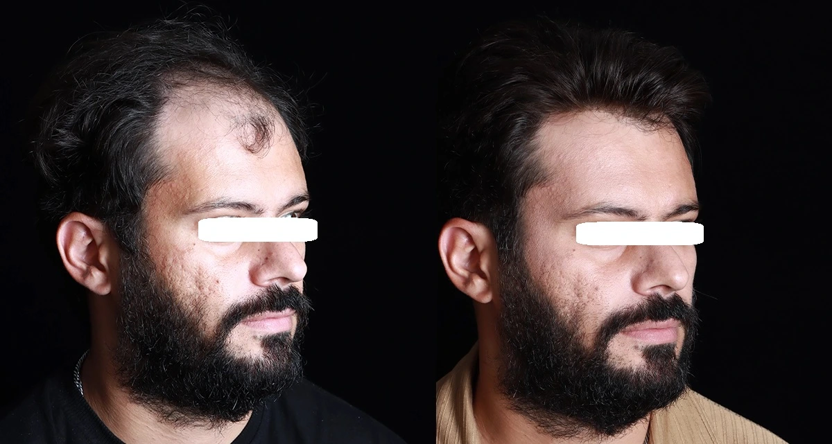 مراحل کاشت مو به روش Super FUE