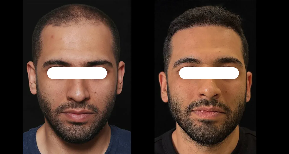 کاشت مو با روش fit