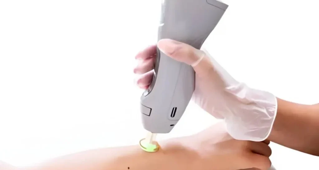 فرق لیزر شاتی و رولی