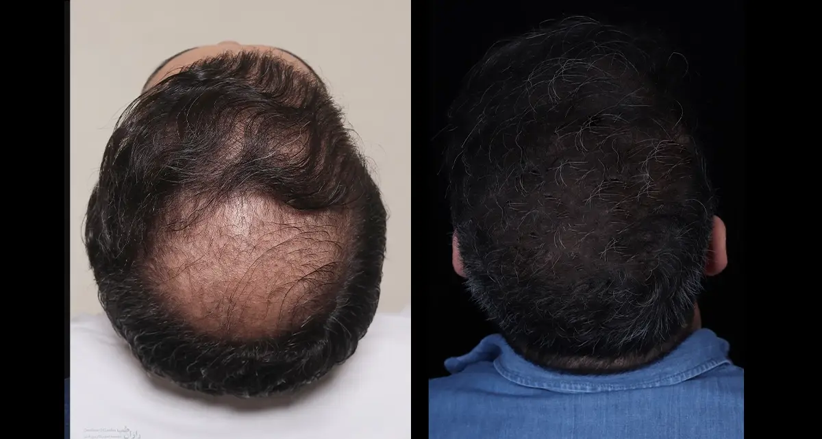 کاشت مو به روش SUT