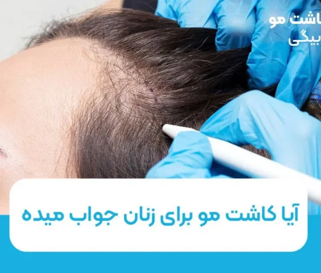 آیا کاشت مو برای زنان جواب میده