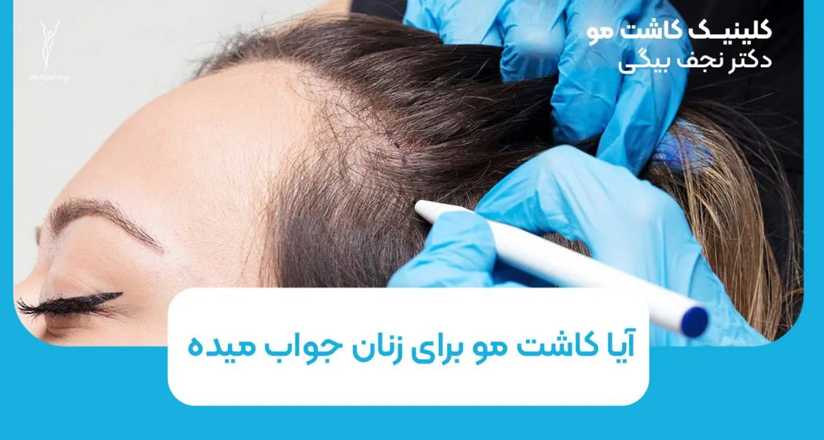 آیا کاشت مو برای زنان جواب میده؟