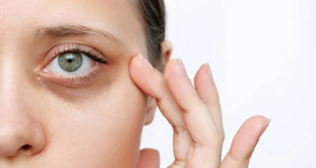 بهترین درمان سیاهی دور چشم