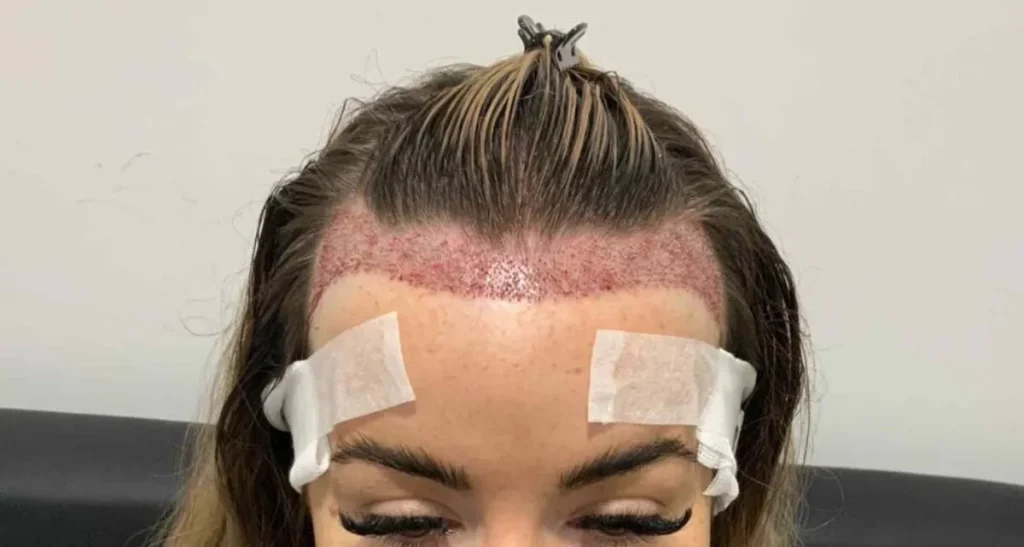 بهترین سن کاشت مو در زنان چه زمانی است؟