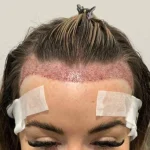 بهترین سن کاشت مو در زنان