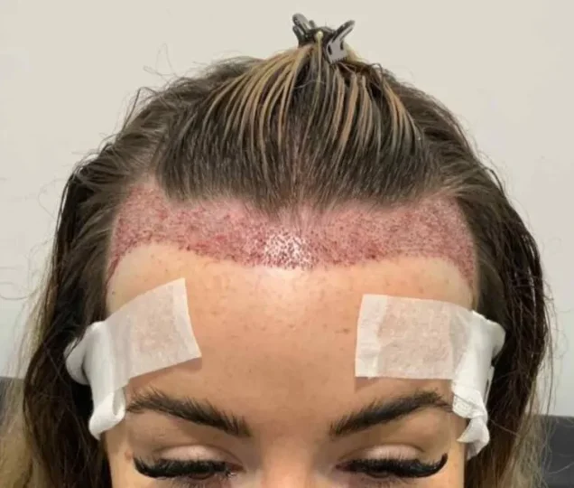 بهترین سن کاشت مو در زنان