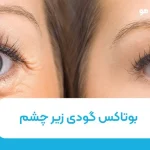 بوتاکس گودی زیر چشم چقدر موثر است