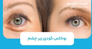 بوتاکس گودی زیر چشم چقدر موثر است