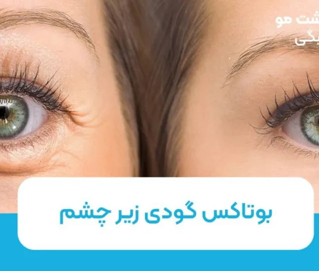بوتاکس گودی زیر چشم چقدر موثر است