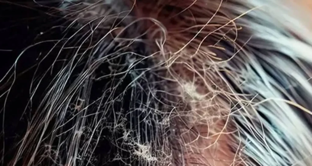 بیماری های ساقه مو به همراه راهکار درمان