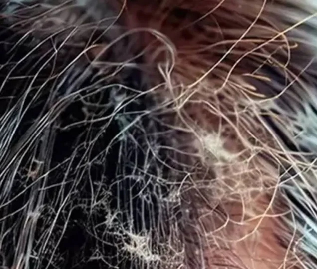 بیماری های ساقه مو به همراه راهکار درمان