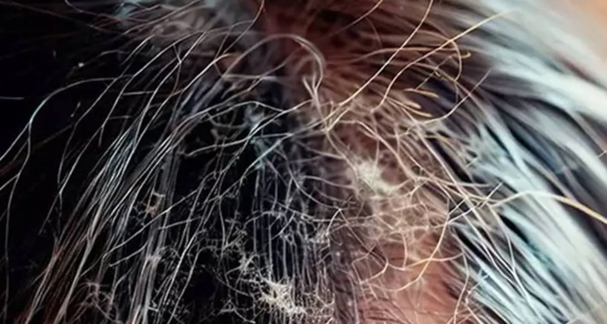 بیماری های ساقه مو به همراه راهکار درمان