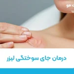 درمان جای سوختگی لیزر و لک ناشی از آن