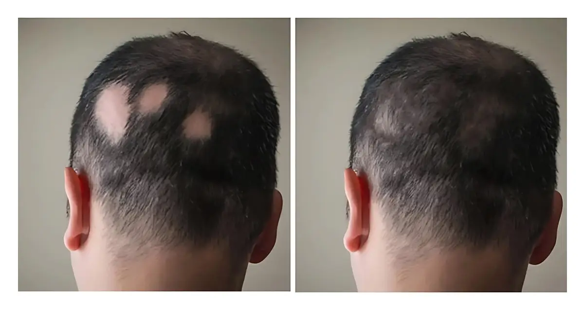 درمان ریزش سکه ای