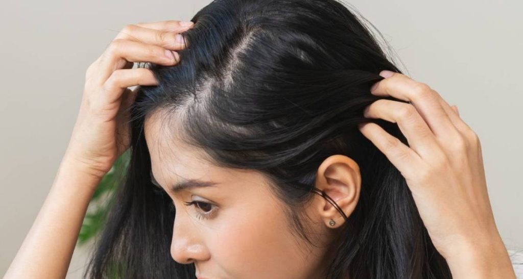 ریزش موی آندروژنیک طرح زنانه+ علت و درمان