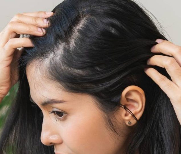 ریزش موی آندروژنیک در زنان